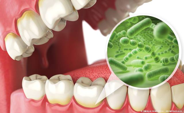 Parodontosebehandlung bei Zahnfleischbluten und Zahnlockerung
