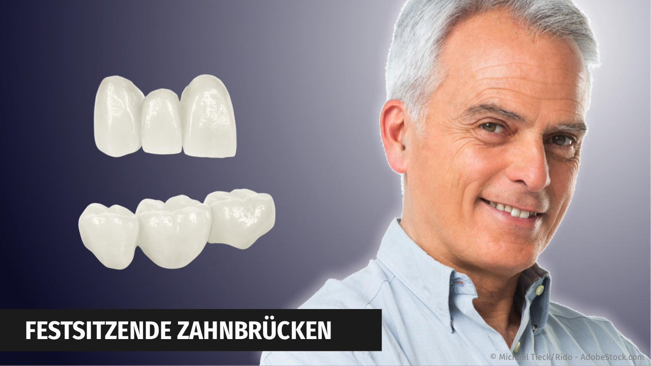 Zahnbrücken aus Keramik mit CEREC