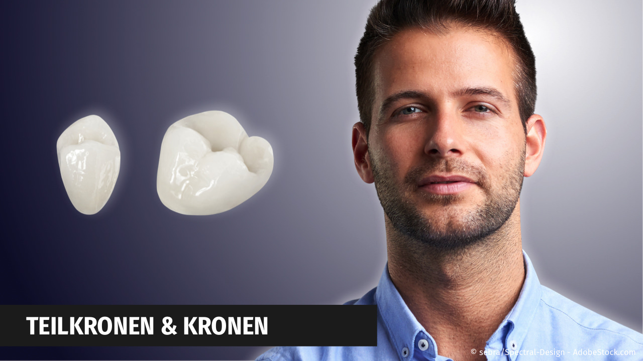 CEREC: Kronen und Teilkronen aus Keramik